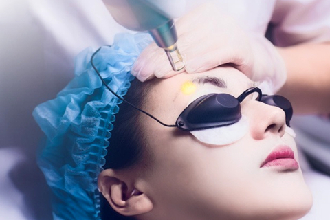 Xoá Laser chân mày