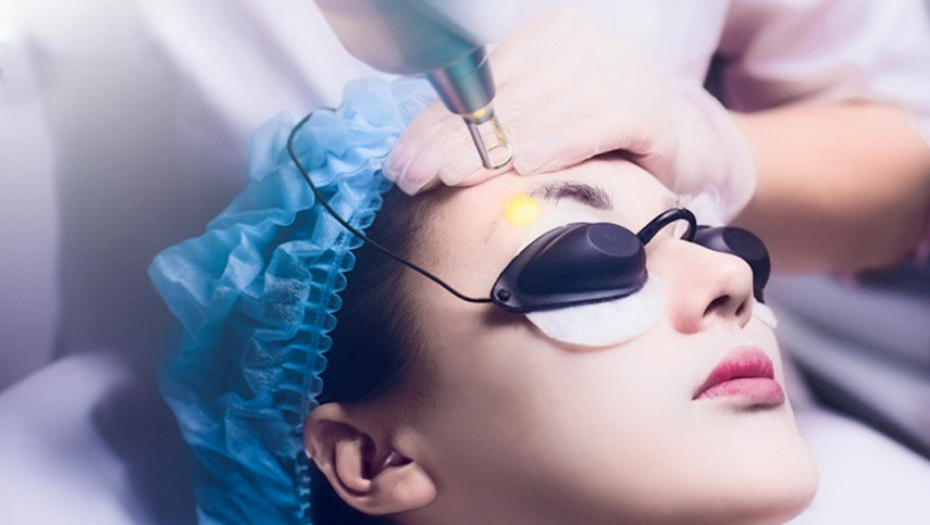 Xoá Laser chân mày